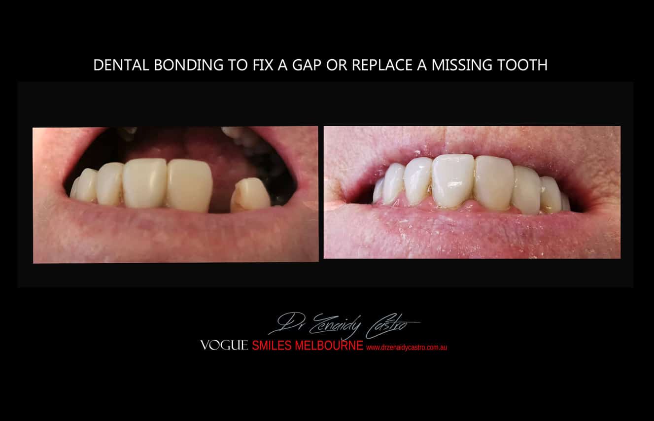 Tooth Bonding for gaps between teeth Melbourne CBD, composite bonding gap front teeth, Cosmetic Bonding, bonding gaps in teeth cost, gaps in front teeth