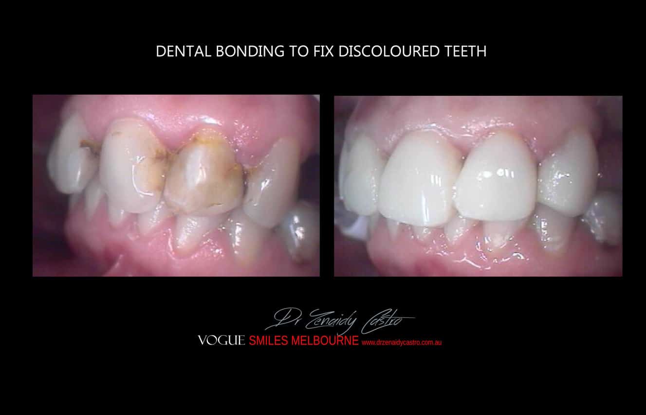 Composite Veneers Melbourne CBD, Composite Resin Bonding Melbourne CBD, Composite Bonding, Same day smile Melbourne CBD