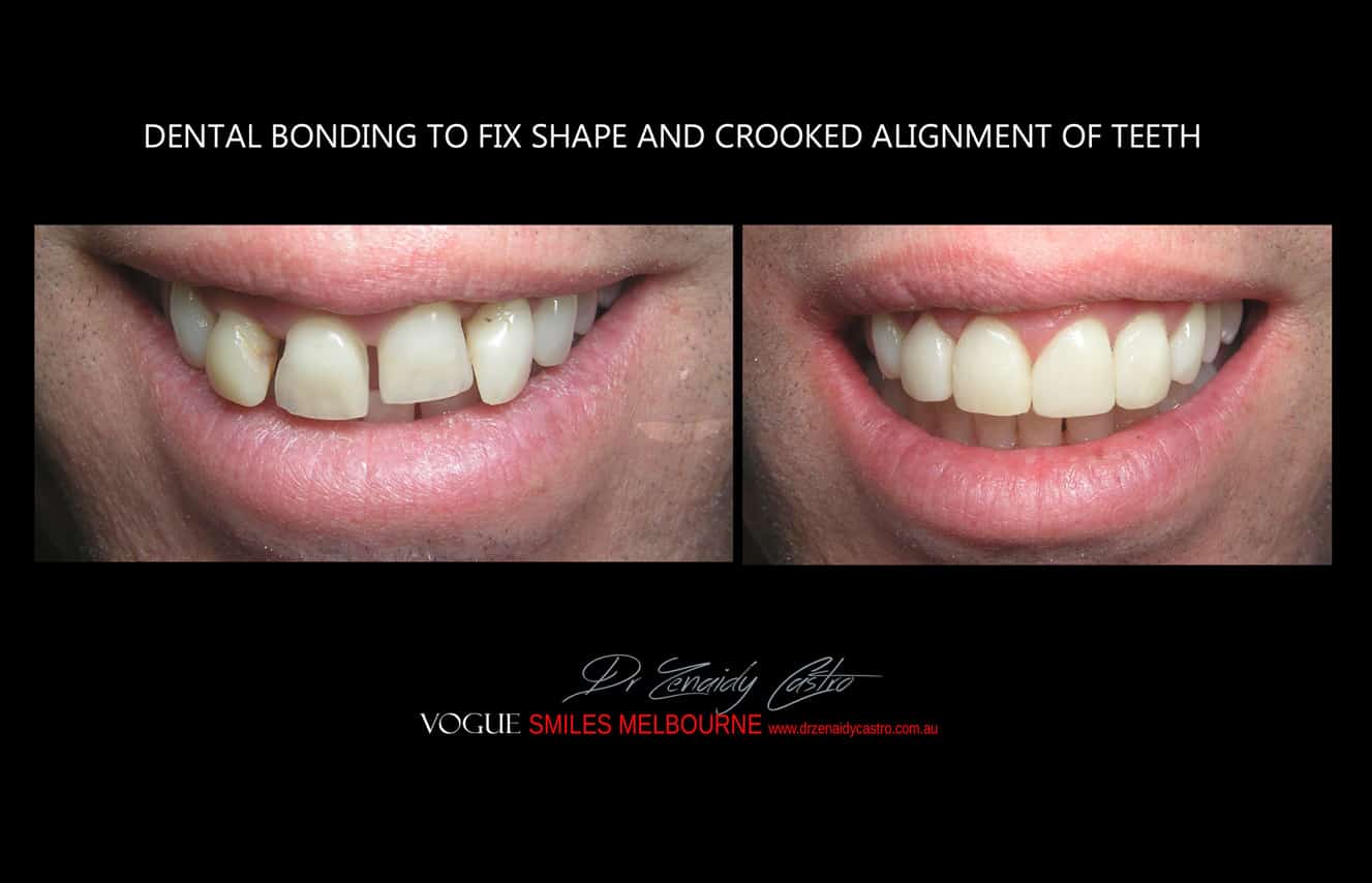 Composite Veneers Melbourne CBD, Composite Resin Bonding Melbourne CBD, Composite Bonding, Same day smile Melbourne CBD