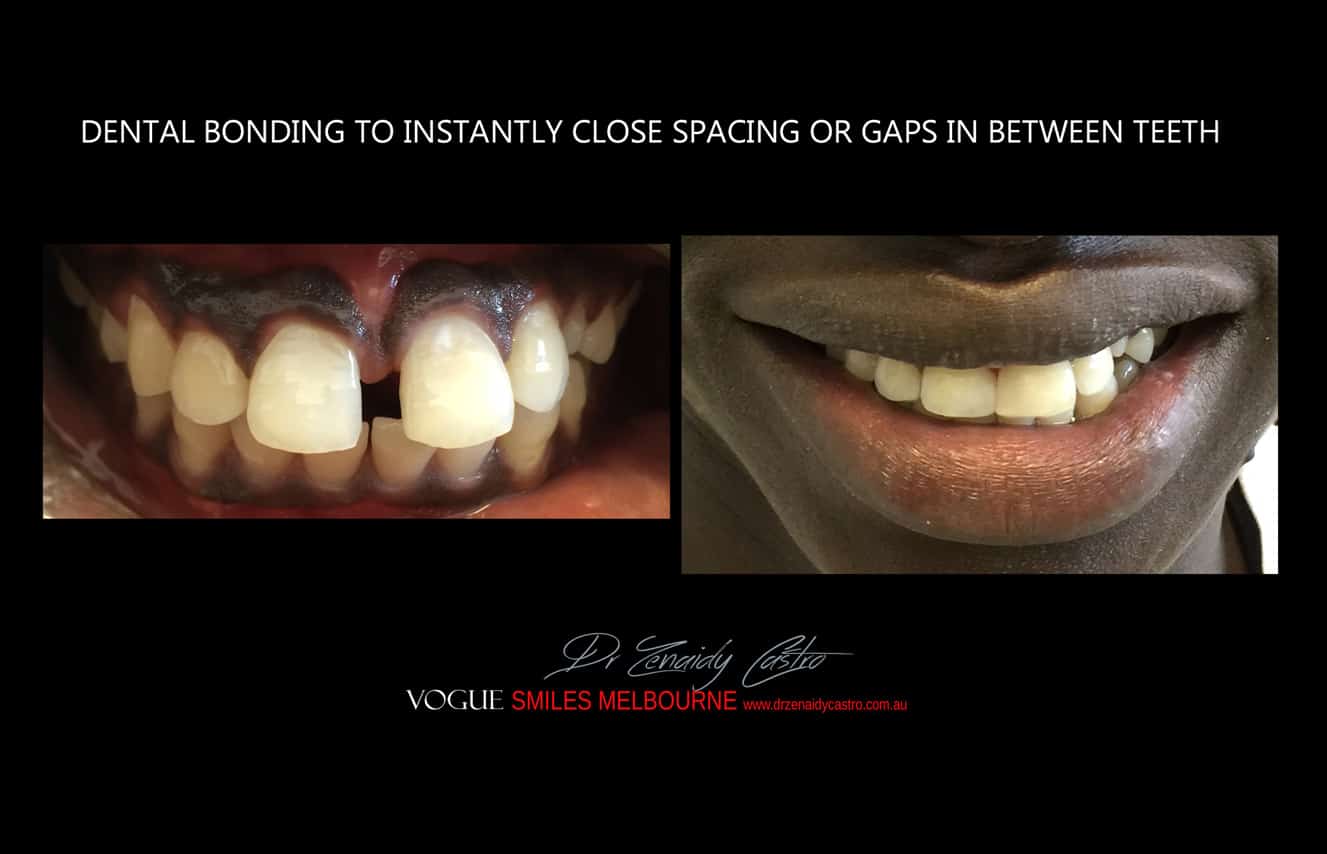 Composite Bonding resin veneers Melbourne CBD- Cosmetic Dentist Melbourne