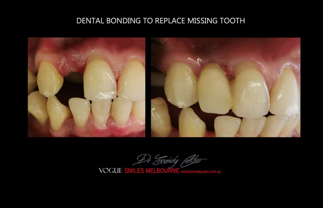 Composite Veneers Melbourne CBD, Composite Resin Bonding Melbourne CBD, Composite Bonding, Same day smile Melbourne CBD