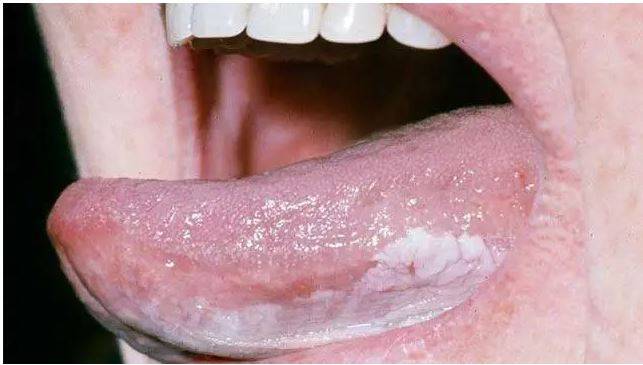 Oral Cancer. Mouth Cancer - Oral Cancer Screening Melbourne CBD MELBOURNE