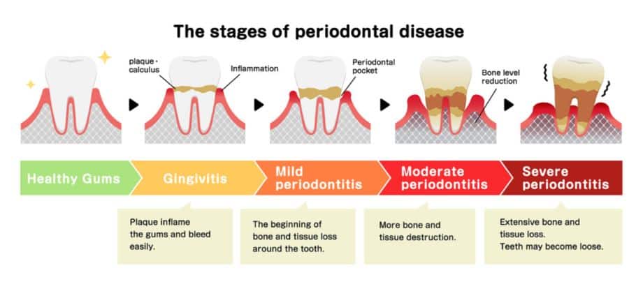 Loose Tooth, Wobbly Tooth, Wiggling Adult Tooth