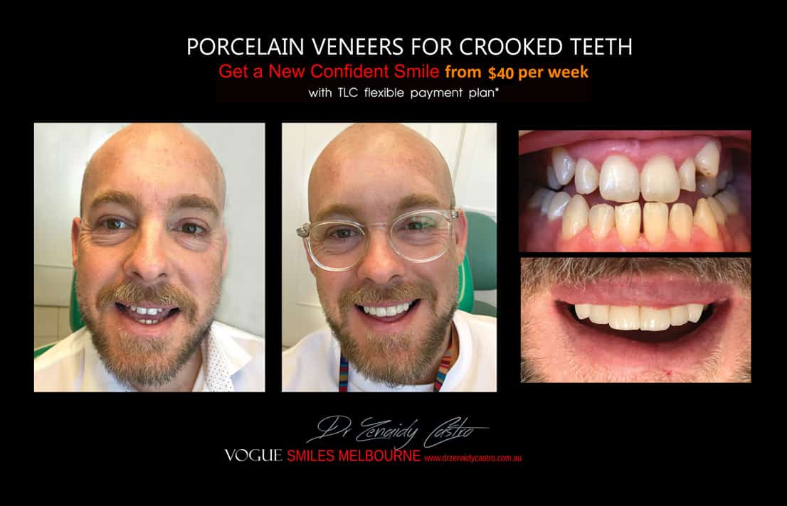 Straighten Overlapping, Crooked, and Crowded teeth Melbourne CBD City 3000 Victoria Australia