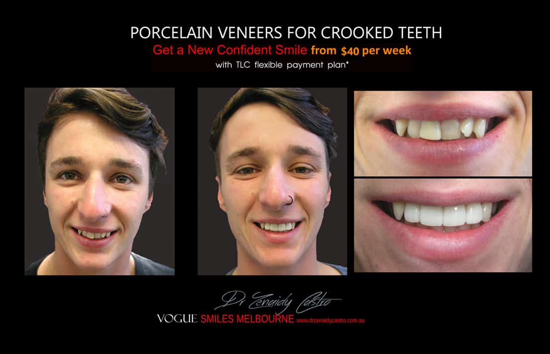 instantly straighten Crooked teeth with Porcelain veneers Melbourne CBD Cosmetic Dentist