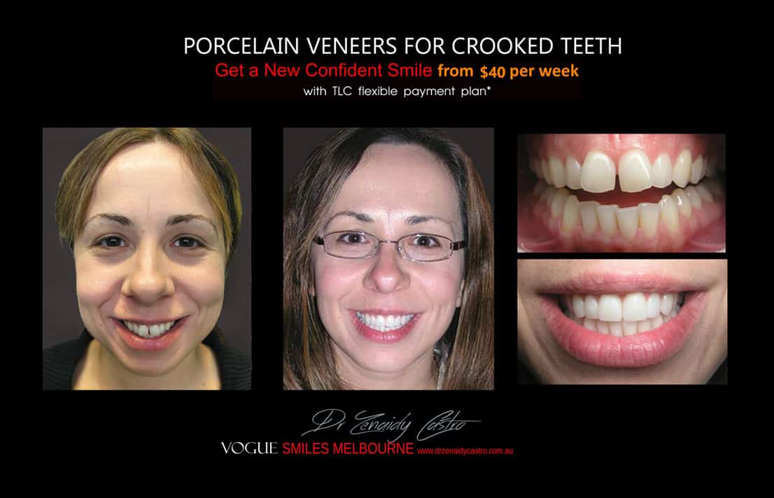 Porcelain Veneers versus Invisalign, Veneers Vs Braces or Invisalign, invisalign vs veneers cost, Should I get Invisalign or dental veneers?, What is better veneers or Invisalign?, Porcelain Veneer for crooked teeth before and after Melbourne