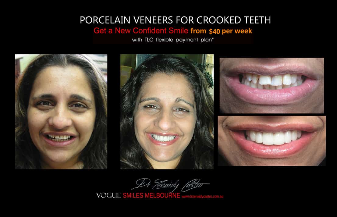 Porcelain Veneers versus Invisalign, Veneers Vs Braces or Invisalign, invisalign vs veneers cost, Should I get Invisalign or dental veneers?, What is better veneers or Invisalign?, Porcelain Veneer for crooked teeth before and after Melbourne