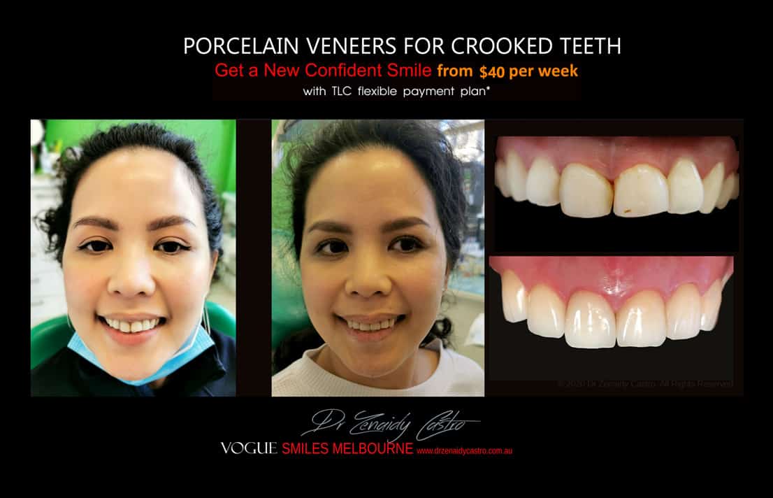 instantly straighten Crooked teeth with Porcelain veneers Melbourne CBD Cosmetic Dentist