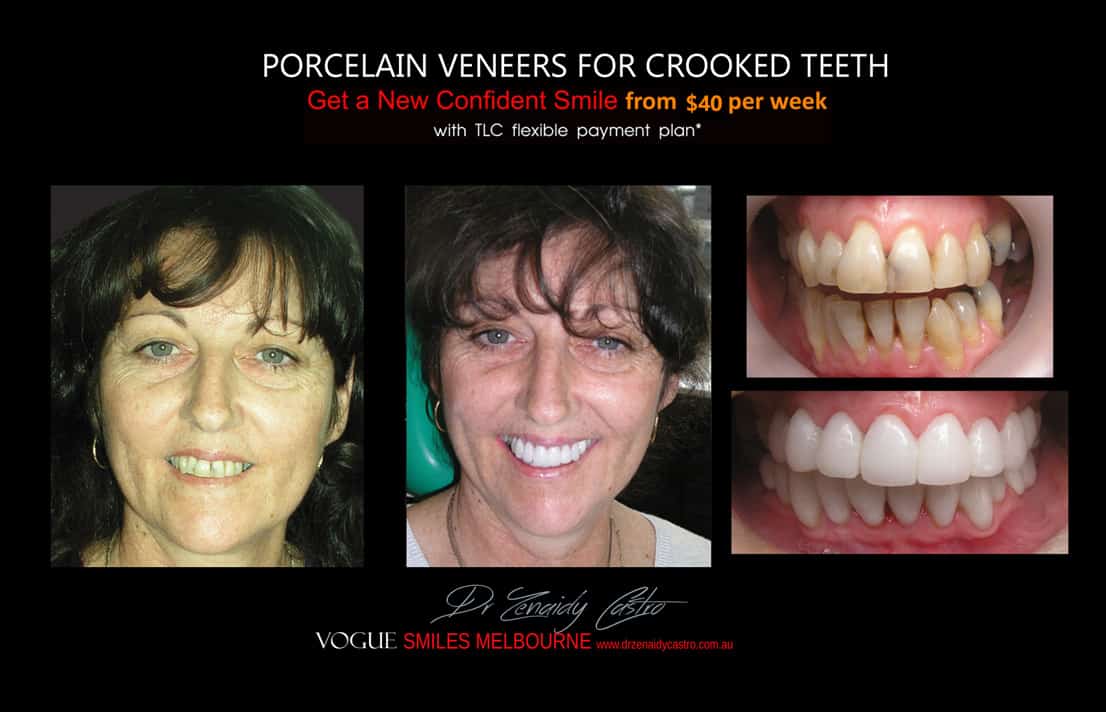 Porcelain Veneers versus Invisalign, Veneers Vs Braces or Invisalign, invisalign vs veneers cost, Should I get Invisalign or dental veneers?, What is better veneers or Invisalign?, Porcelain Veneer for crooked teeth before and after Melbourne