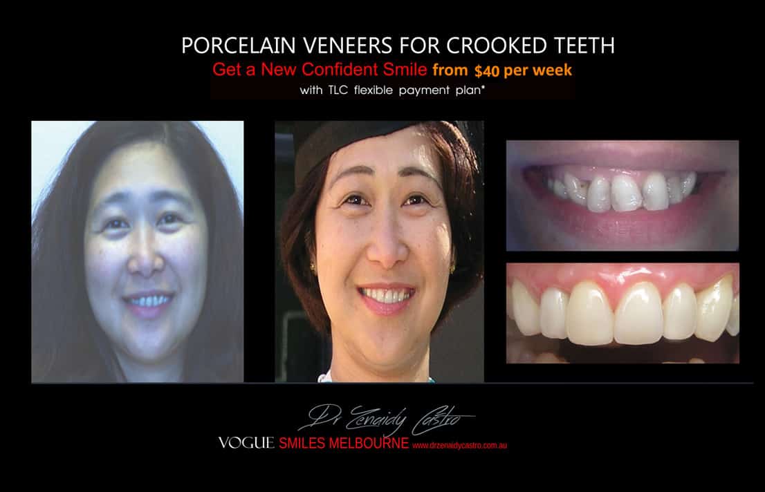 Porcelain Veneers versus Invisalign, Veneers Vs Braces or Invisalign, invisalign vs veneers cost, Should I get Invisalign or dental veneers?, What is better veneers or Invisalign?, Porcelain Veneer for crooked teeth before and after Melbourne