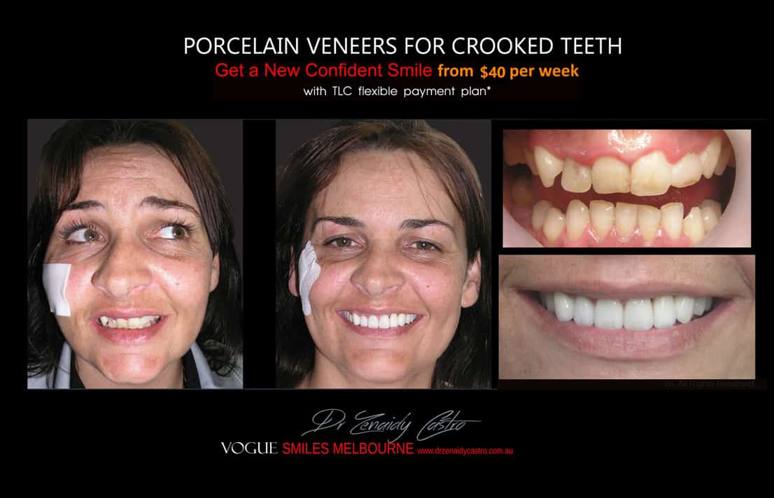 instantly straighten Crooked teeth with Porcelain veneers Melbourne CBD Cosmetic Dentist