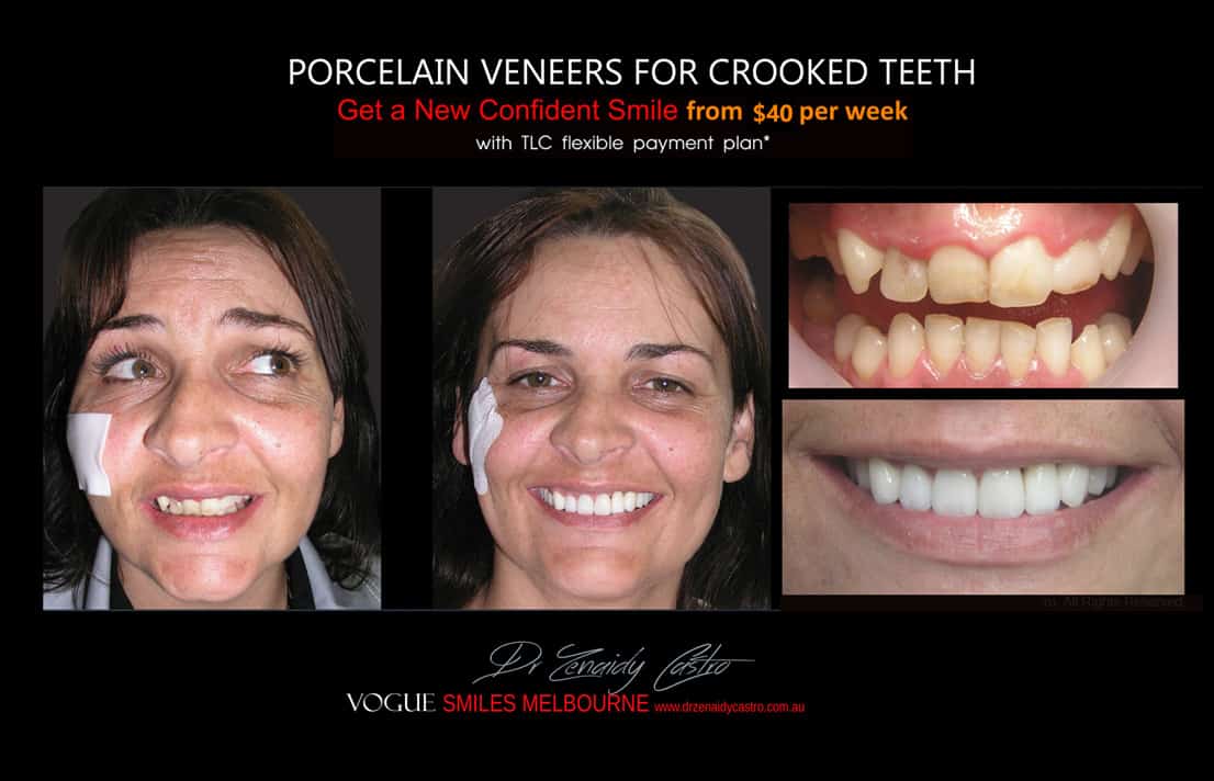 Porcelain Veneers versus Invisalign, Veneers Vs Braces or Invisalign, invisalign vs veneers cost, Should I get Invisalign or dental veneers?, What is better veneers or Invisalign?, Porcelain Veneer for crooked teeth before and after Melbourne