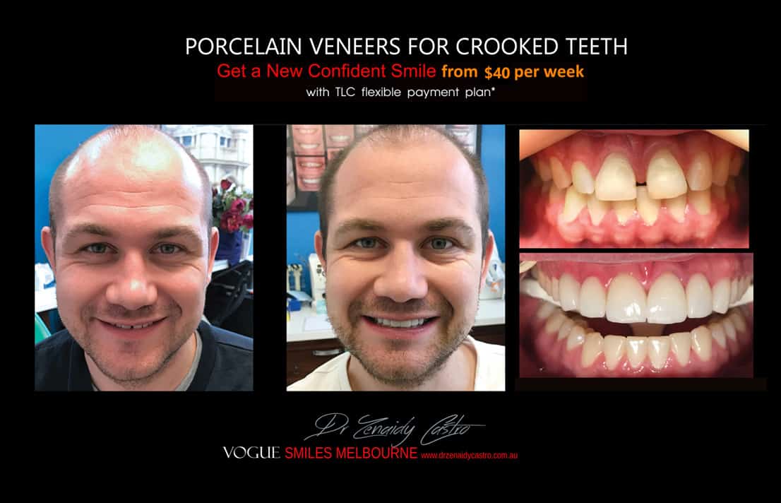 PORCELAIN VENEERS FOR CROOKED TEETH BEFORE AND AFTER MELBOURNE CBD COSMETIC DENTIST