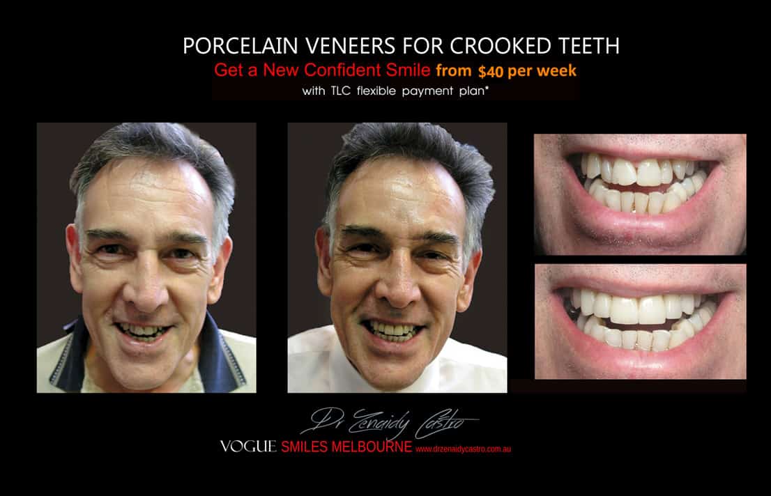 instantly straighten Crooked teeth with Porcelain veneers Melbourne CBD Cosmetic Dentist