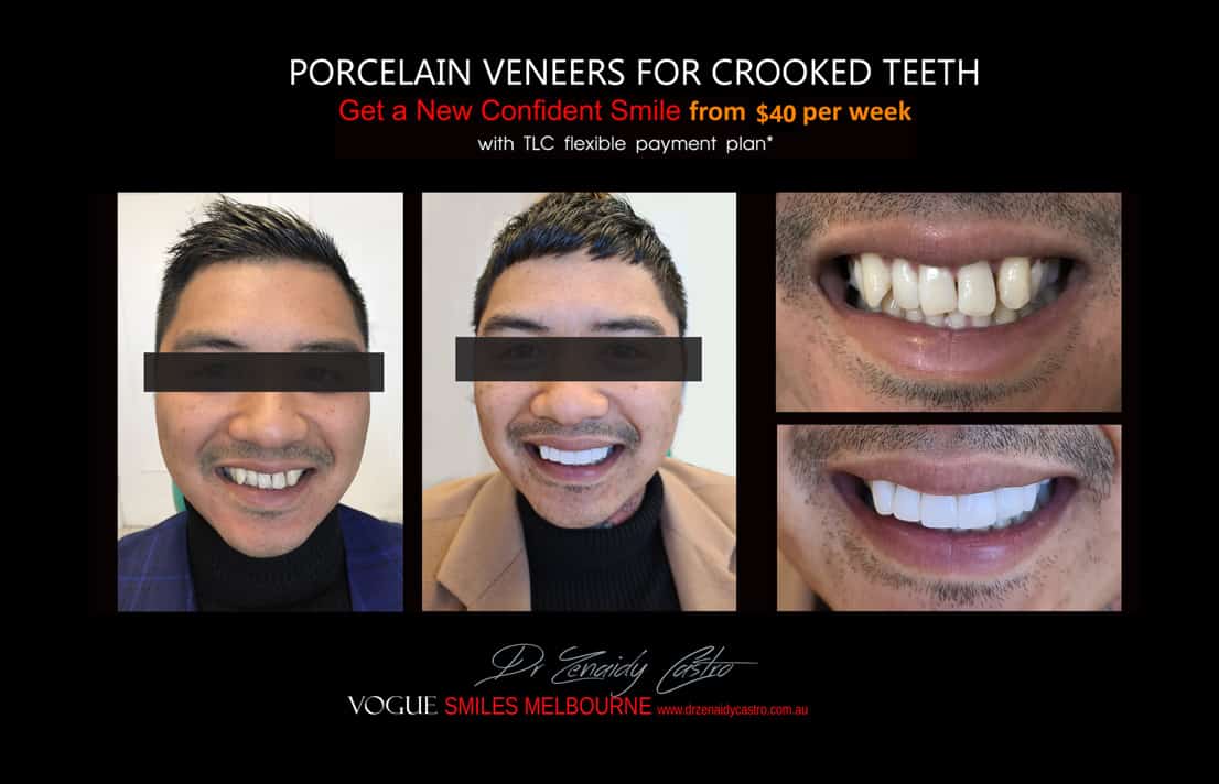 Porcelain Veneers versus Invisalign, Veneers Vs Braces or Invisalign, invisalign vs veneers cost, Should I get Invisalign or dental veneers?, What is better veneers or Invisalign?, Porcelain Veneer for crooked teeth before and after Melbourne