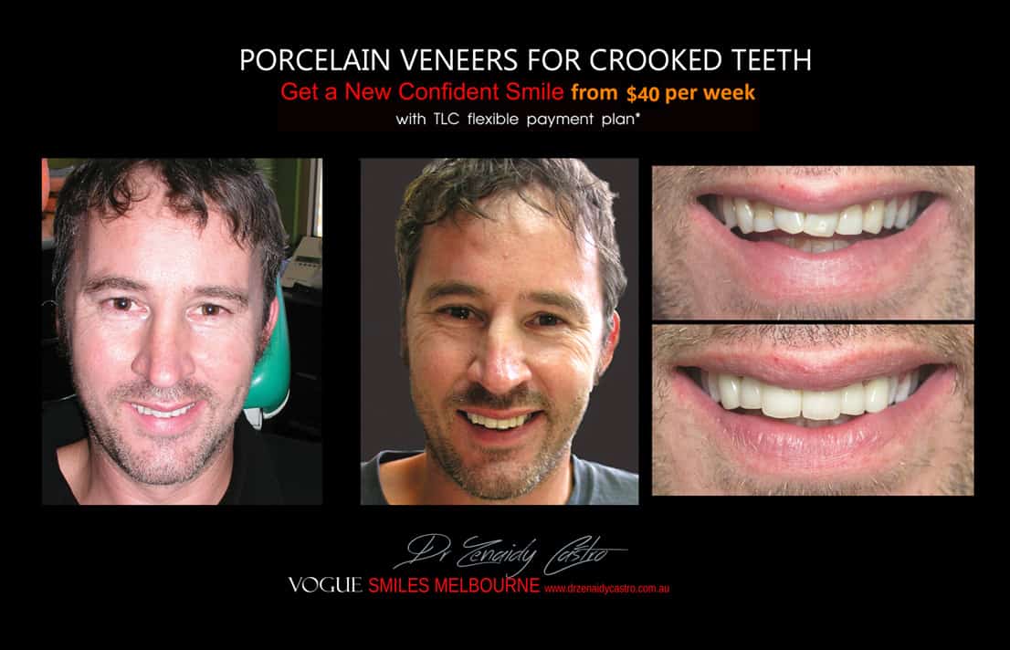 instantly straighten Crooked teeth with Porcelain veneers Melbourne CBD Cosmetic Dentist