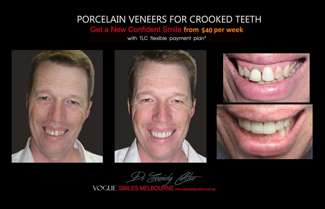 Straighten Overlapping, Crooked, and Crowded teeth Melbourne CBD City 3000 Victoria Australia