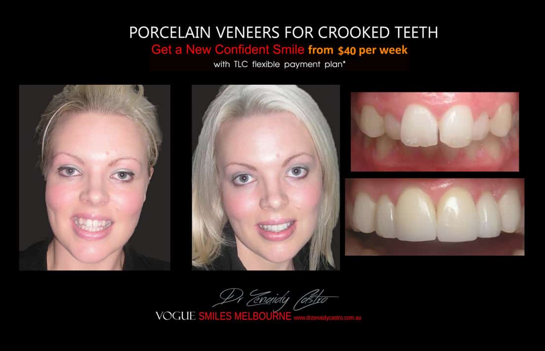 Porcelain Veneers versus Invisalign, Veneers Vs Braces or Invisalign, invisalign vs veneers cost, Should I get Invisalign or dental veneers?, What is better veneers or Invisalign?, Porcelain Veneer for crooked teeth before and after Melbourne