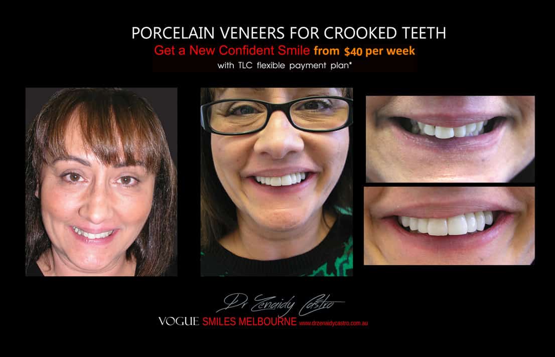 instantly straighten Crooked teeth with Porcelain veneers Melbourne CBD Cosmetic Dentist