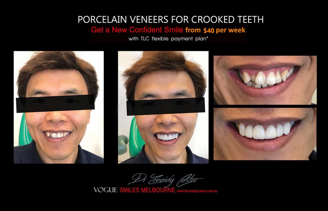 instantly straighten Crooked teeth with Porcelain veneers Melbourne CBD Cosmetic Dentist