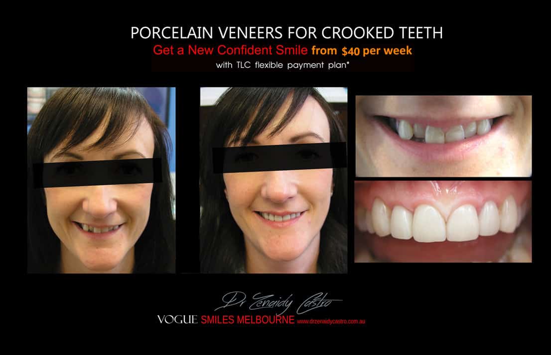 Porcelain Veneers versus Invisalign, Veneers Vs Braces or Invisalign, invisalign vs veneers cost, Should I get Invisalign or dental veneers?, What is better veneers or Invisalign?, Porcelain Veneer for crooked teeth before and after Melbourne