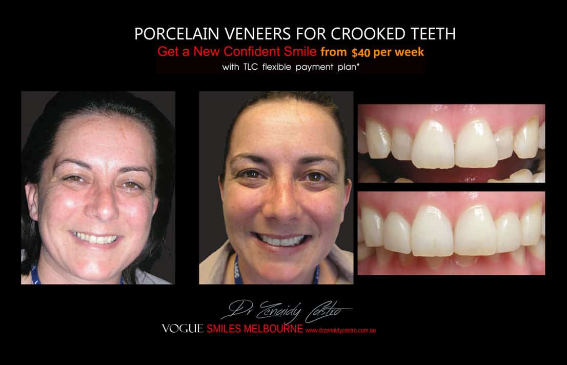 PORCELAIN VENEERS FOR CROOKED TEETH BEFORE AND AFTER MELBOURNE CBD COSMETIC DENTIST