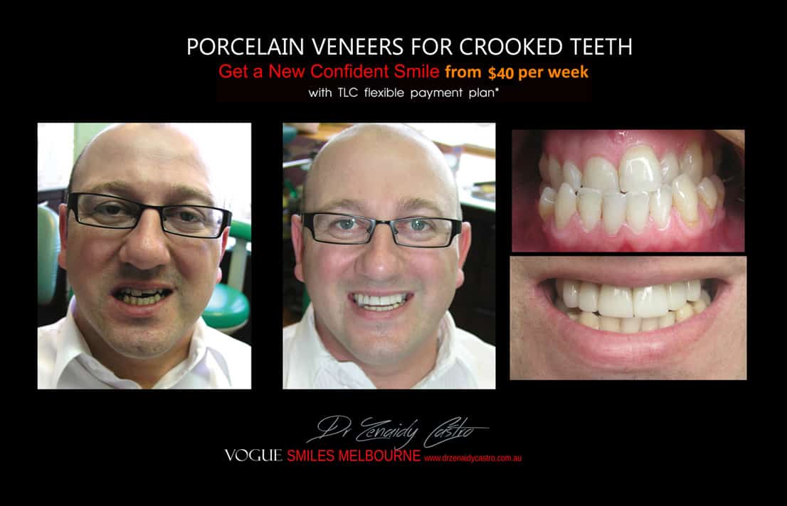 PORCELAIN VENEERS FOR CROOKED TEETH BEFORE AND AFTER MELBOURNE CBD COSMETIC DENTIST