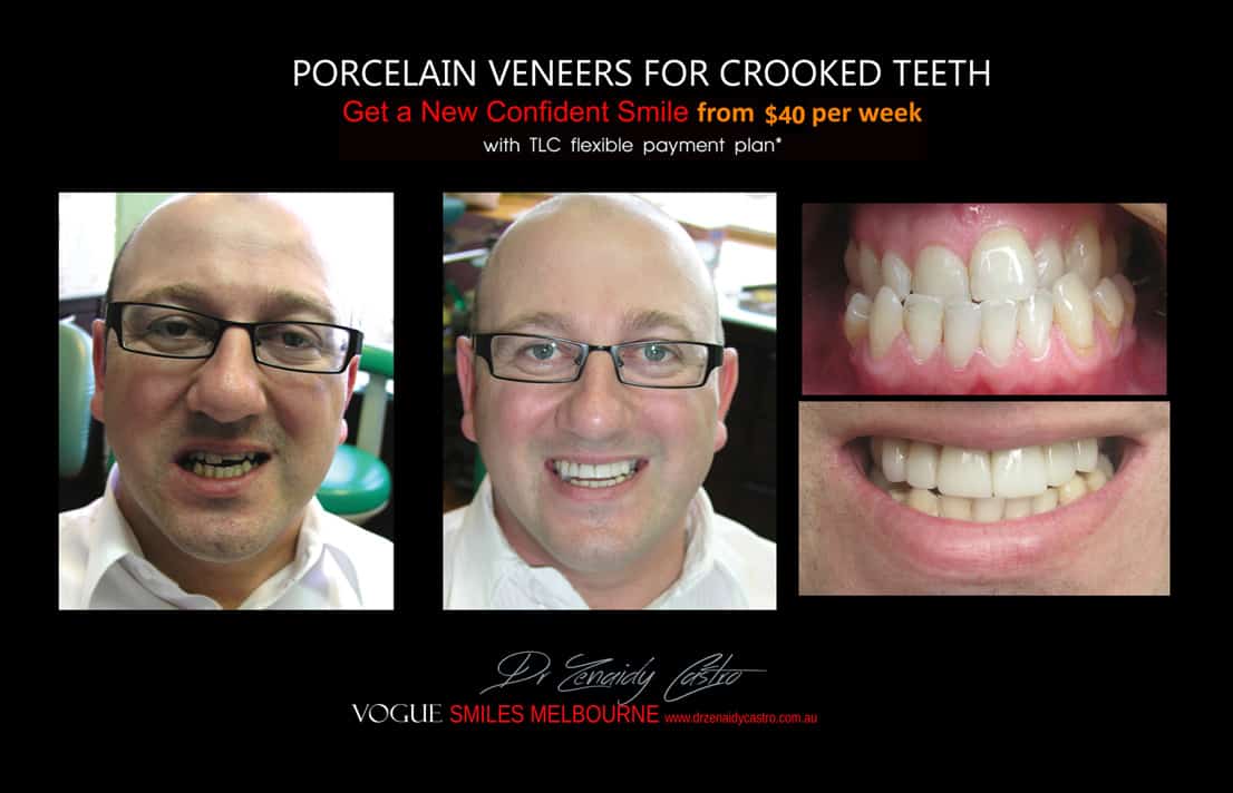 Porcelain Veneers versus Invisalign, Veneers Vs Braces or Invisalign, invisalign vs veneers cost, Should I get Invisalign or dental veneers?, What is better veneers or Invisalign?, Porcelain Veneer for crooked teeth before and after Melbourne