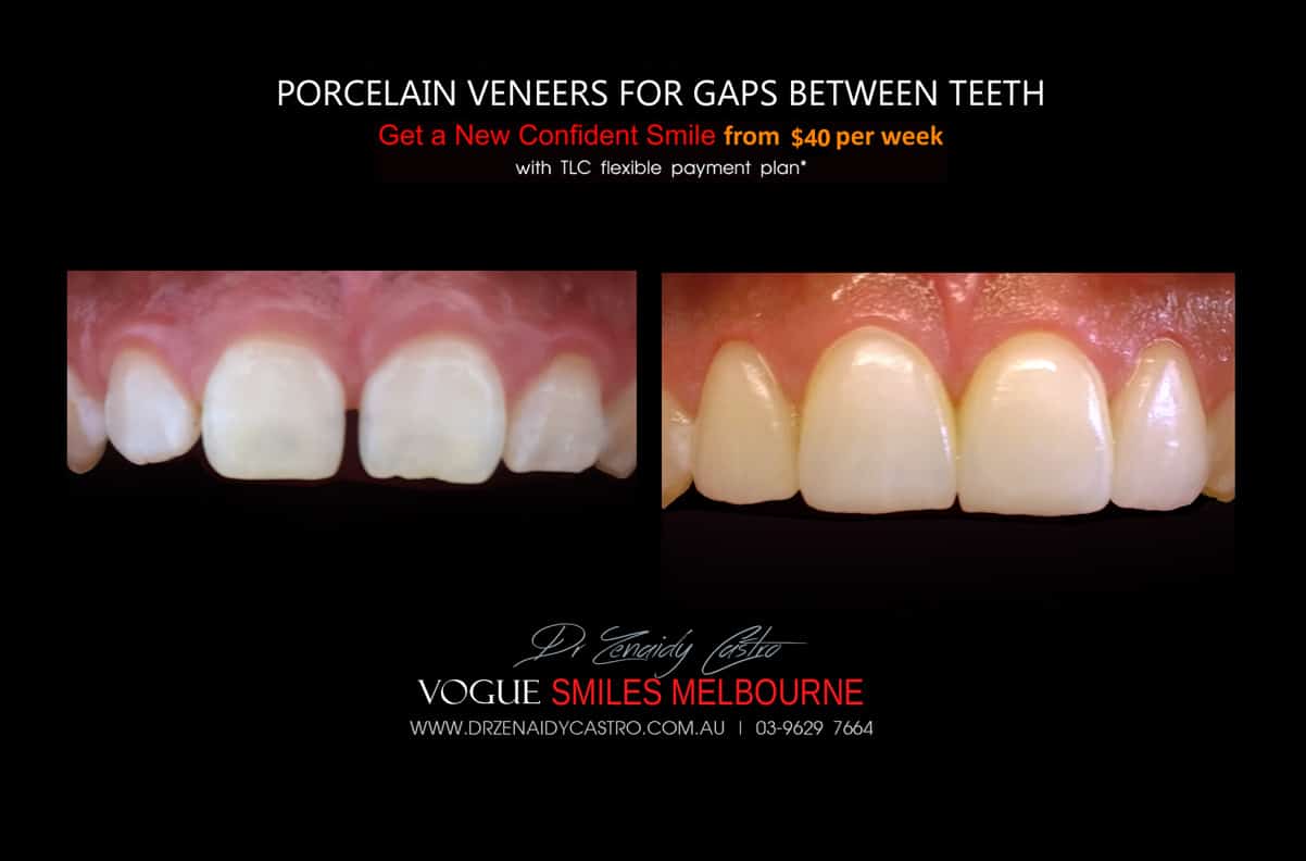 Close Gaps and Spaces between Front Teeth with Porcelain Veneer- Top cosmetic dentist in Melbourne