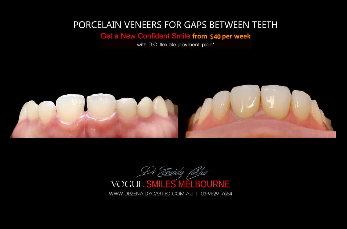 Close Gaps and Spaces between Front Teeth with Porcelain Veneer- Top cosmetic dentist in Melbourne