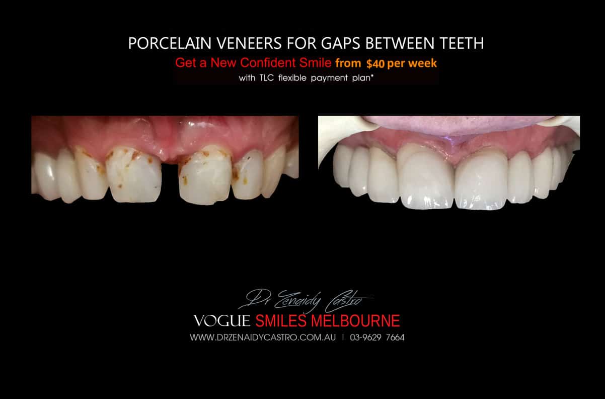 Porcelain Veneers for Gaps in between teeth Melbourne CBD cosmetic dentist - close diastema