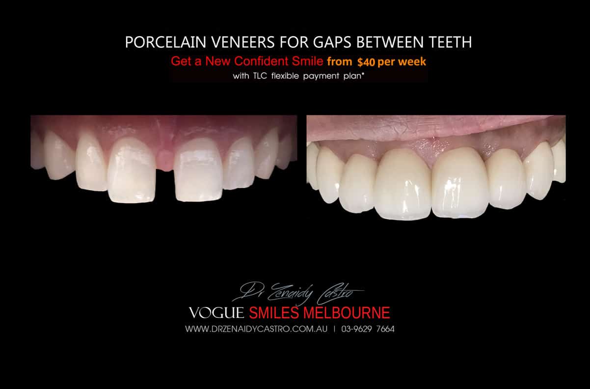 Close Gaps and Spaces between Front Teeth with Porcelain Veneer- Top cosmetic dentist in Melbourne