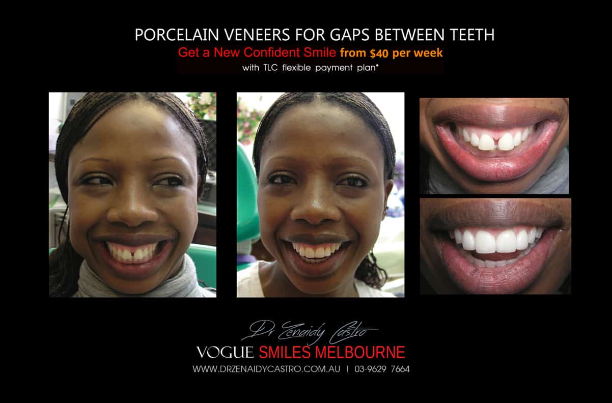 Close Gaps and Spaces between Front Teeth with Porcelain Veneer- Top cosmetic dentist in Melbourne