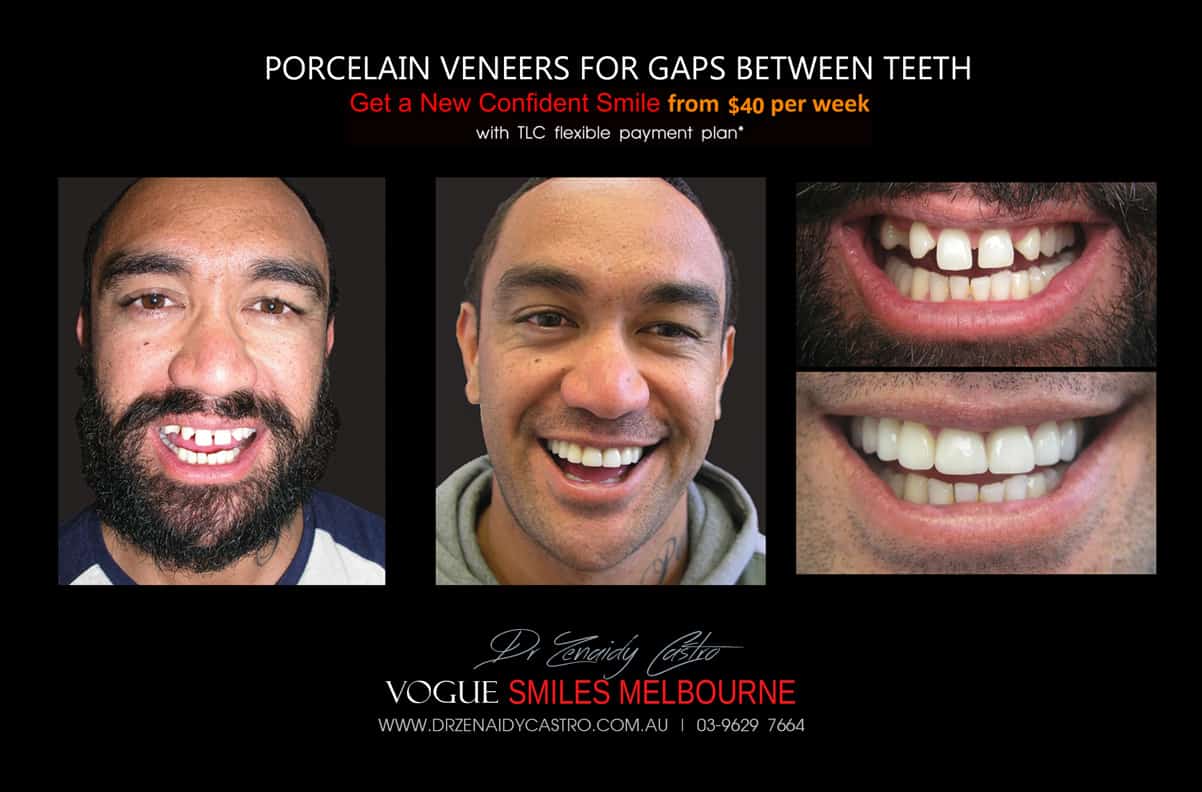 Close Gaps and Spaces between Front Teeth with Porcelain Veneer- Top cosmetic dentist in Melbourne