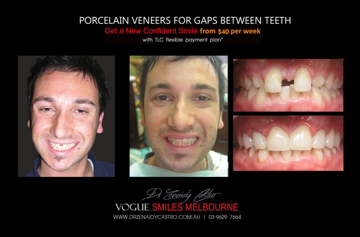 Close Gaps and Spaces between Front Teeth with Porcelain Veneer- Top cosmetic dentist in Melbourne