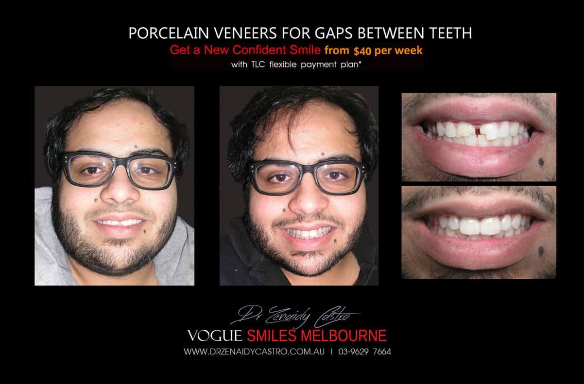 Close Gaps and Spaces between Front Teeth with Porcelain Veneer- Top cosmetic dentist in Melbourne