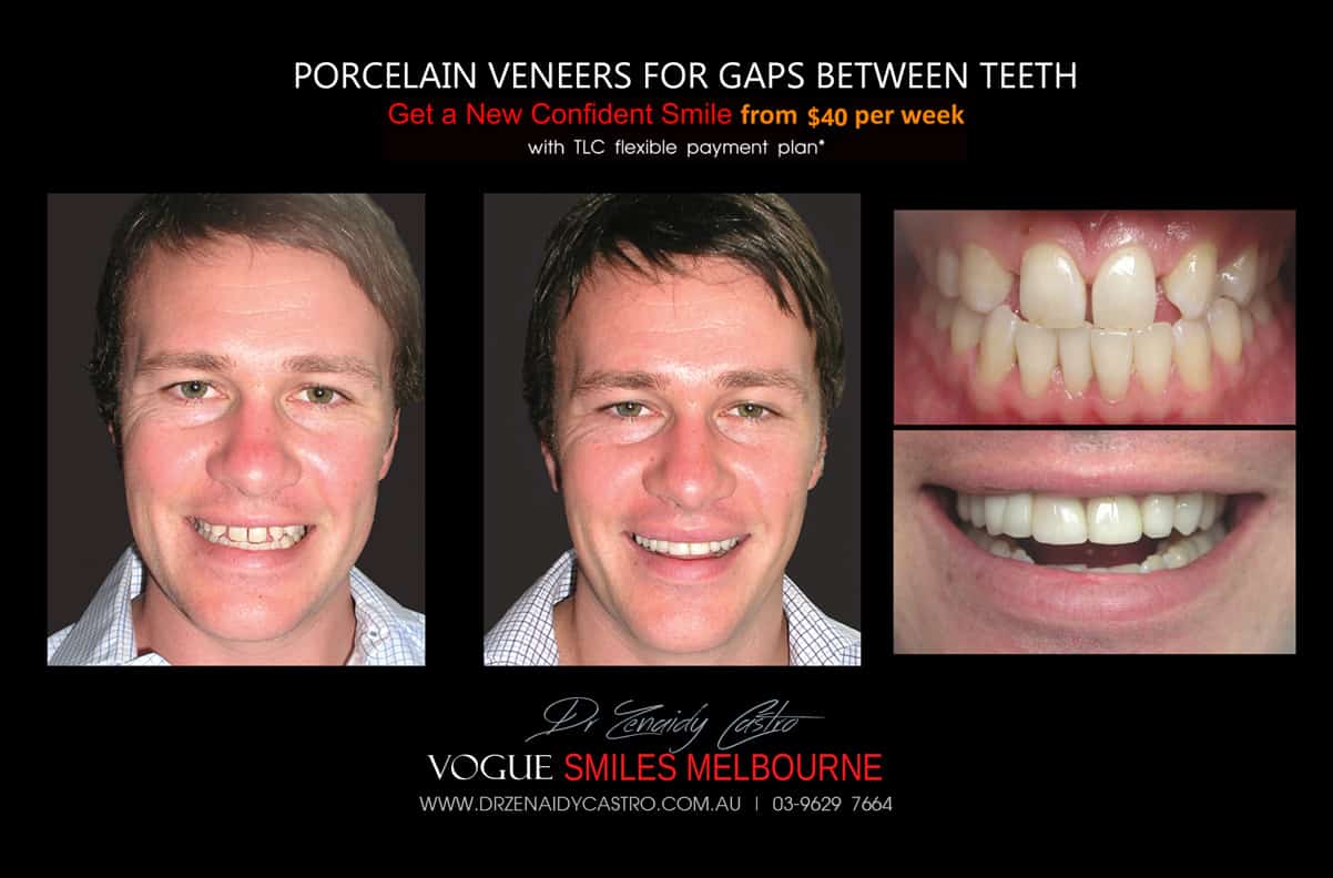 Close Gaps and Spaces between Front Teeth with Porcelain Veneer- Top cosmetic dentist in Melbourne