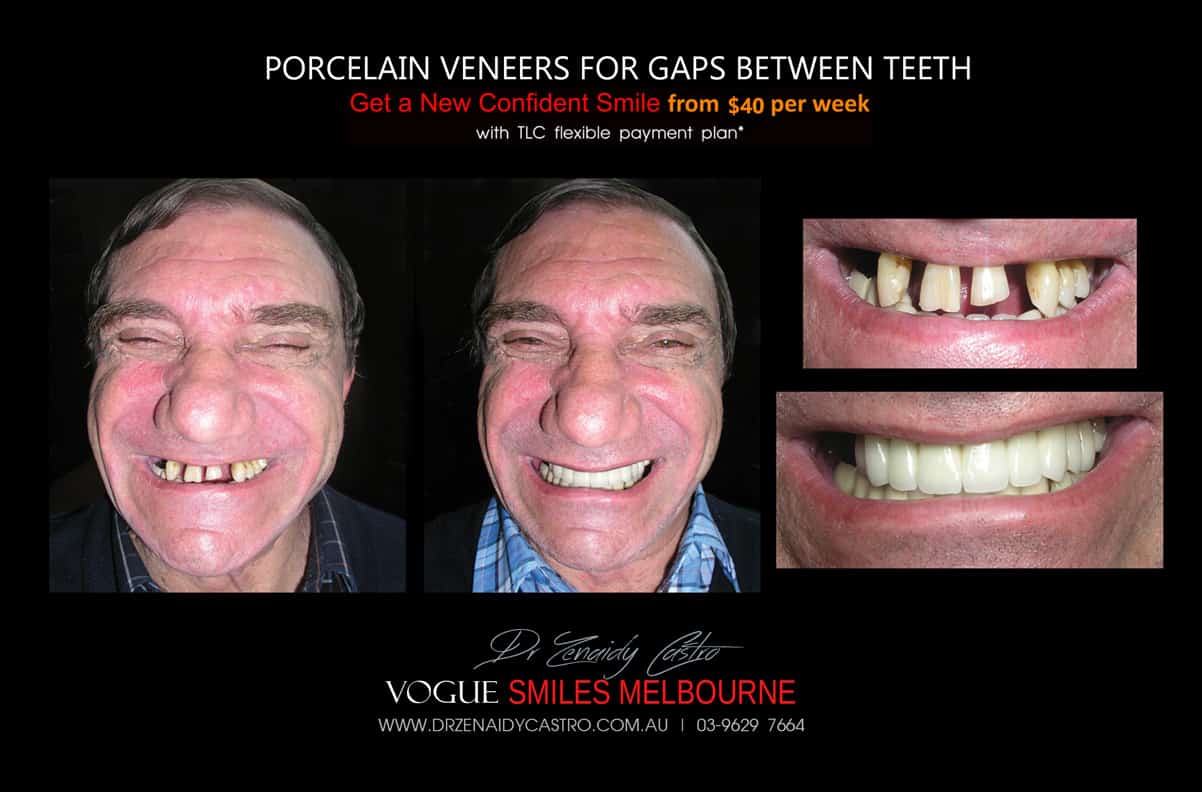 Close Gaps and Spaces between Front Teeth with Porcelain Veneer- Top cosmetic dentist in Melbourne