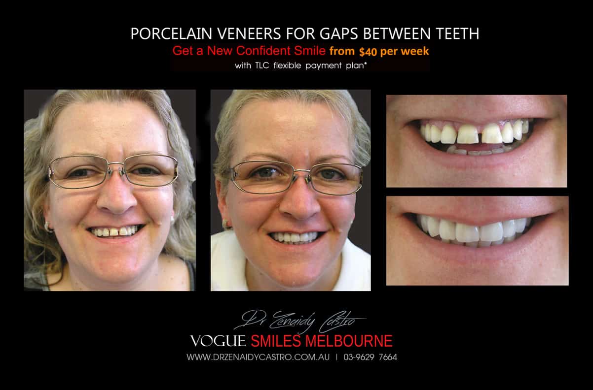 Close Gaps and Spaces between Front Teeth with Porcelain Veneer- Top cosmetic dentist in Melbourne