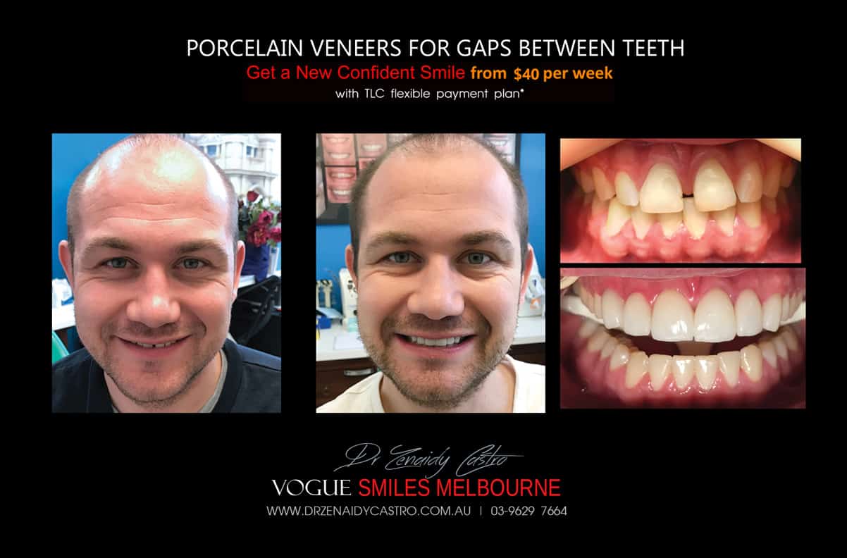 Close Gaps and Spaces between Front Teeth with Porcelain Veneer- Top cosmetic dentist in Melbourne