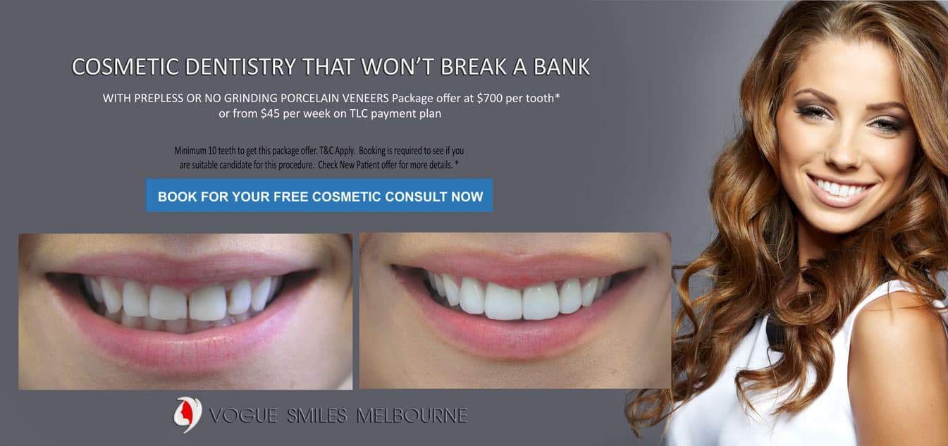 Cost of Dental Veneers in Melbourne, CBD City 3000 Victoria Australia