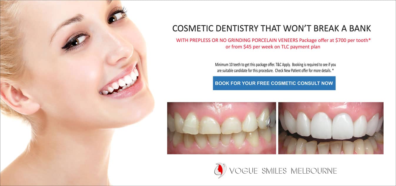 N0-PREP Porcelain Veneers - Dental Veneers without grinding teeth Melbourne