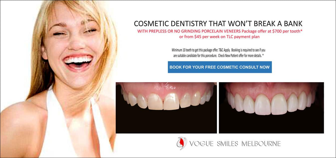 Lumineers Veneers by Vogue Smiles Melbourne