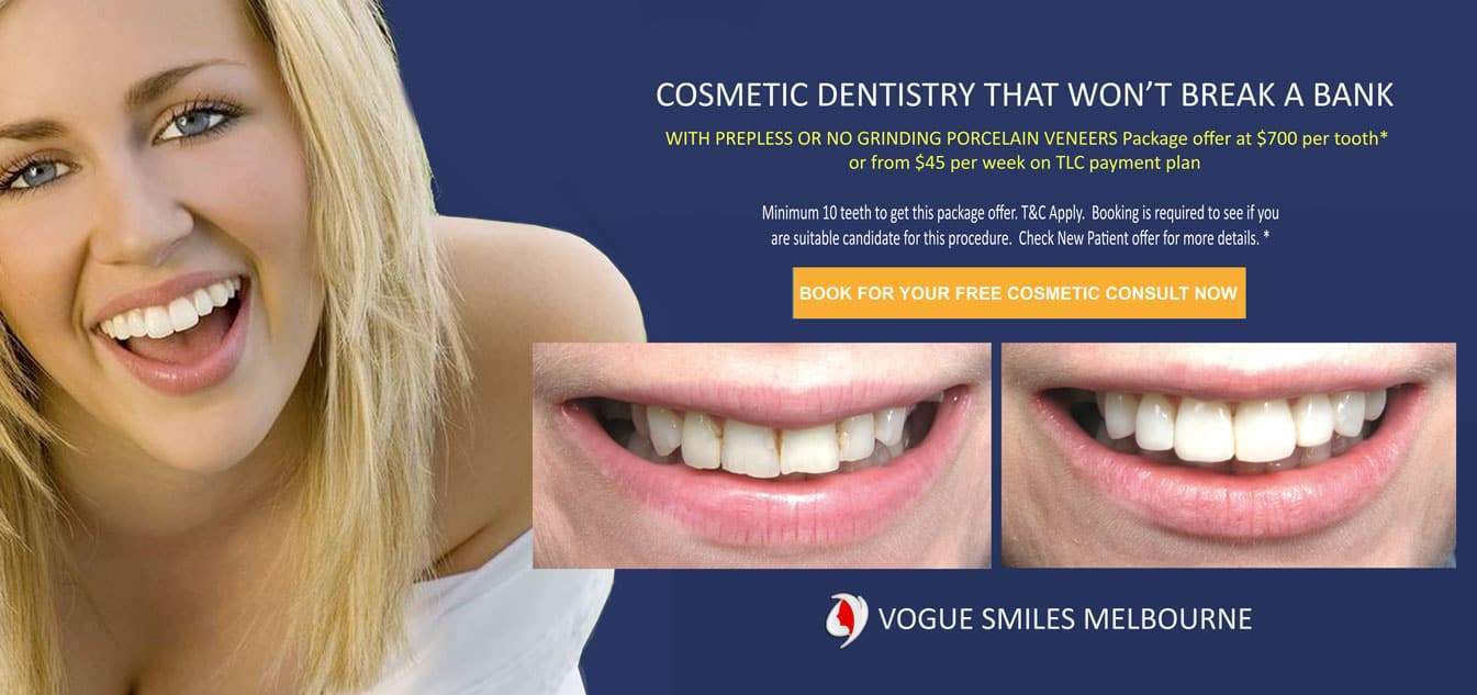 LUMINEERS VENEERS MELBOURNE -COSMETIC DENTIST IN MELBOURNE CBD