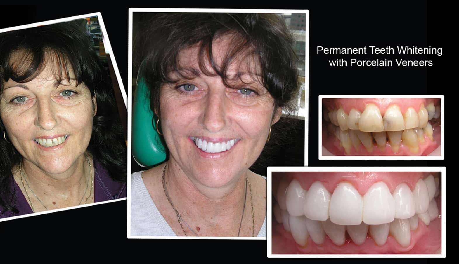 PERMANENT TEETH WHITENING WITH PORCELAIN VENEERS MELBOURNE CBD