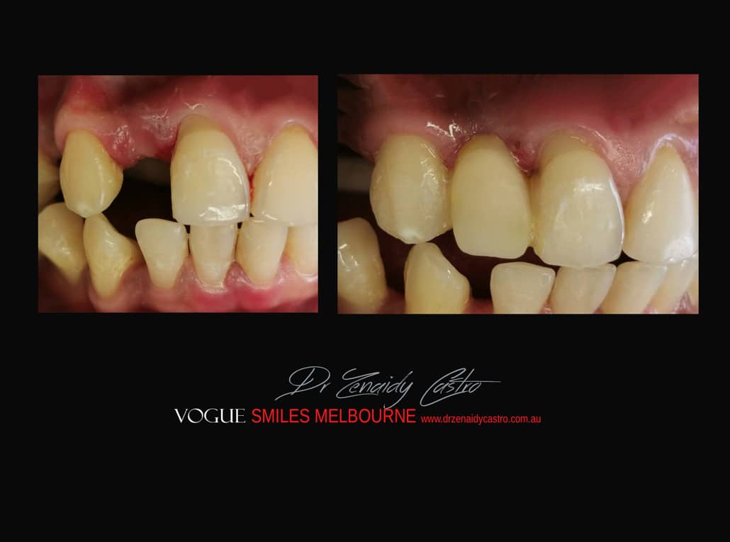 Replace Teeth Instantly - Affordable Same Day Smile Solution Melbourne -Intermediate smile Makeover Solution