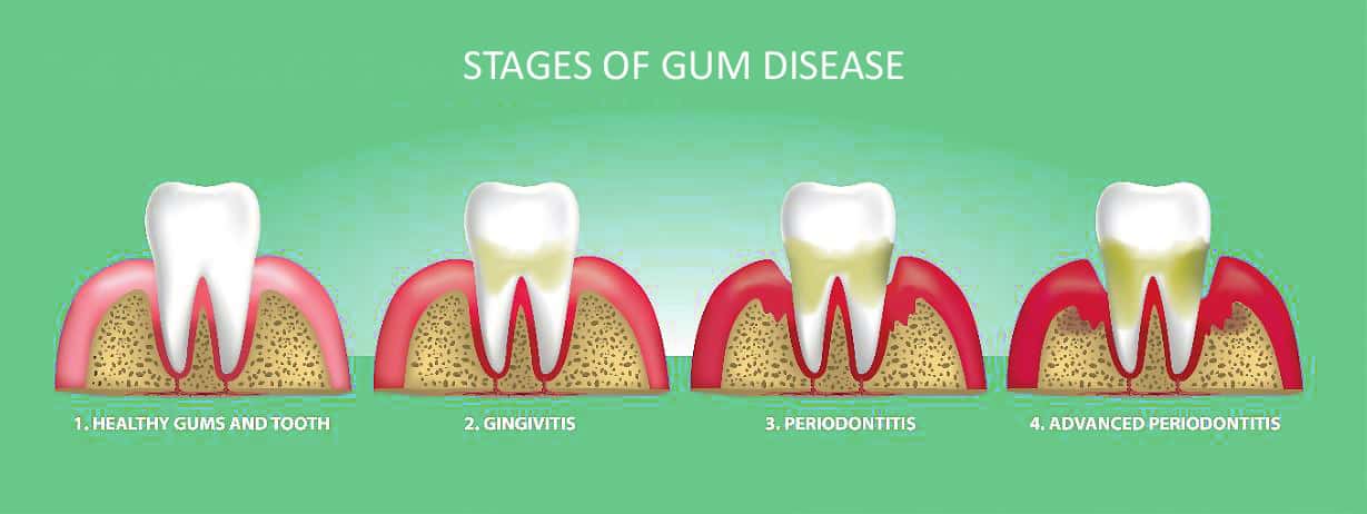 Bleeding Gums, Swollen Gums, Painful Gums Treatment 