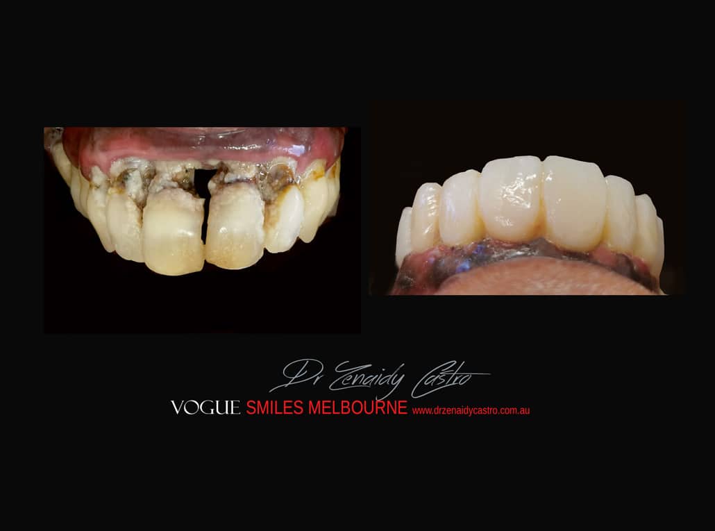 TRANSITIONAL SMILE MAKEOVER Melbourne CBD, Intermediate Cheapest most affordable Cosmetic Dentistry option to improve smile Melbourne Victoria Australia 