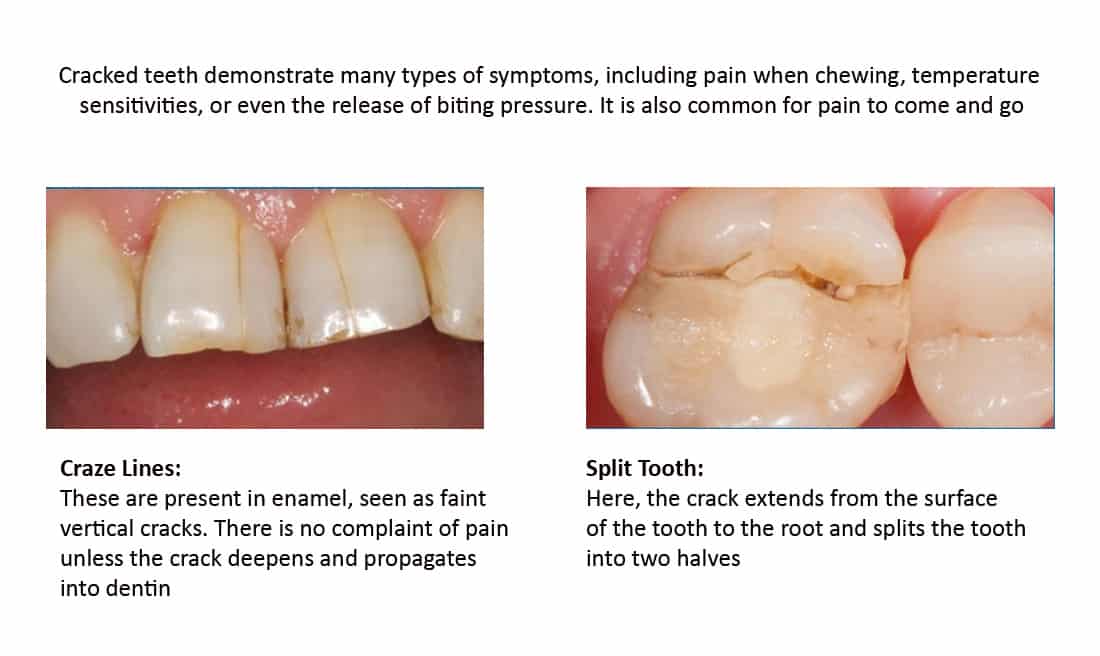 Cracked Tooth and Cracked Tooth Syndrome Treatment Melbourne 