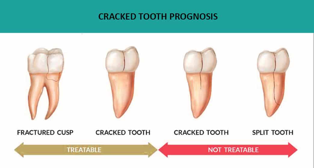 Cracked Tooth and Cracked Tooth Syndrome Treatment Melbourne 